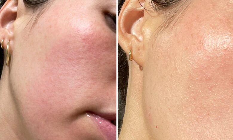 What Is Contact Dermatitis? A Doctor Explains the Skin Condition